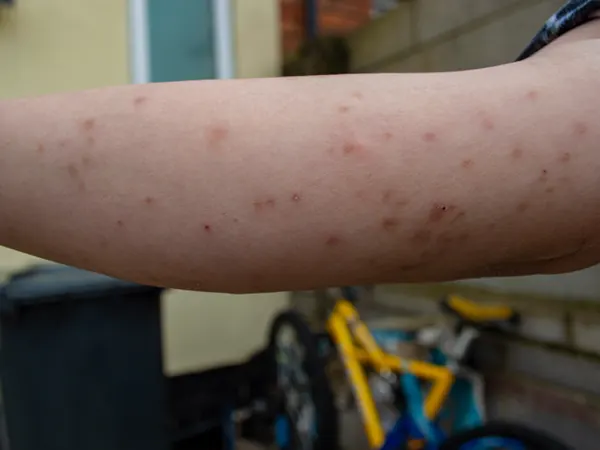 Bed bug bites on a woman's arm